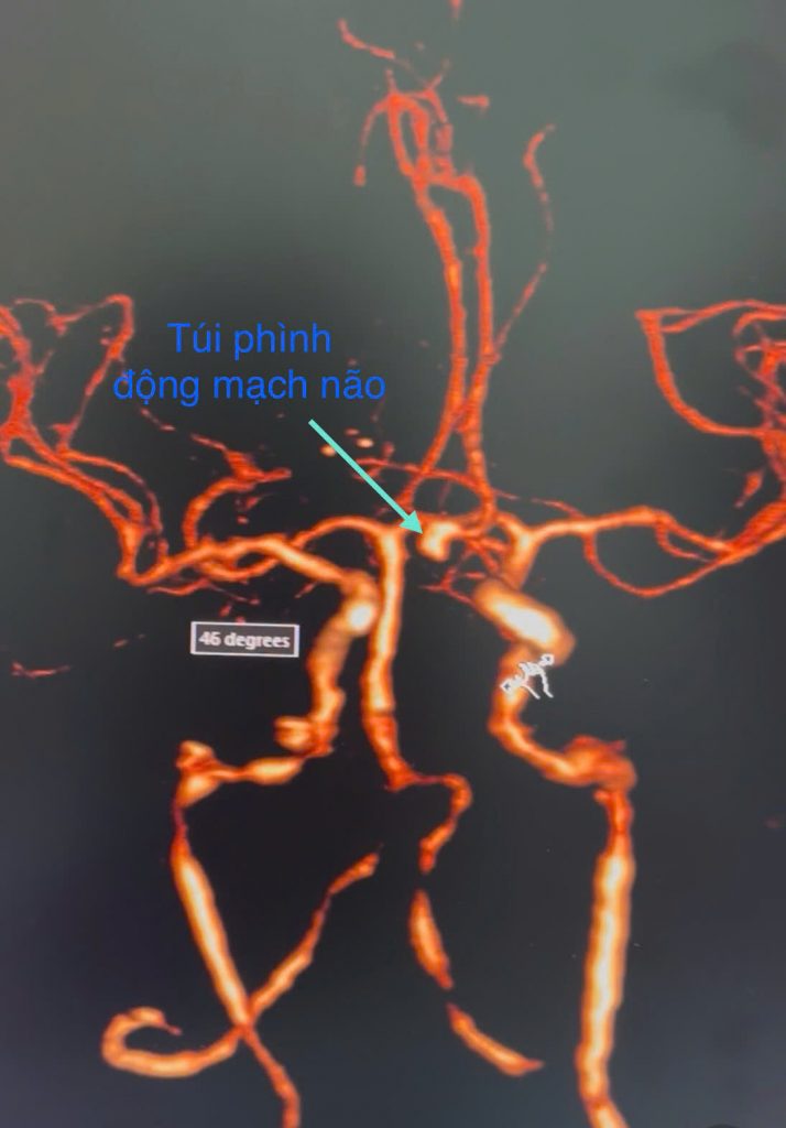 Đột ngột đau đầu trong lúc đang quét nhà, người phụ nữ 48 tuổi đi khám phát hiện vỡ túi phình động mạch não - Ảnh 1.