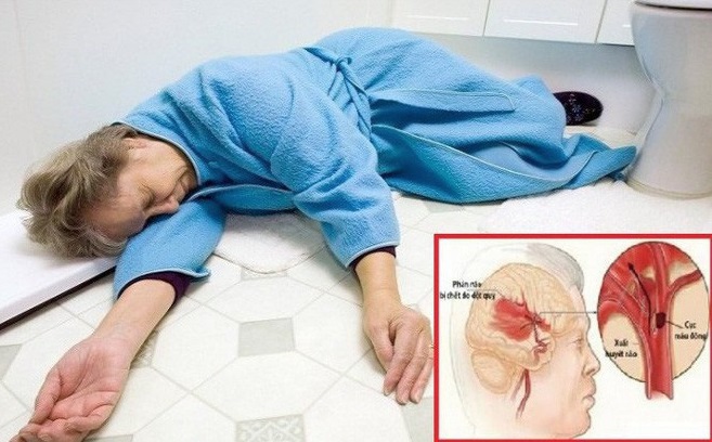 Người phụ nữ bị đột quỵ lúc sáng sớm thừa nhận mắc sai lầm này khi điều trị đau đầu, tăng huyết áp - Ảnh 1.