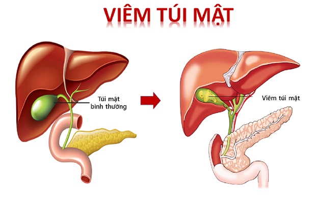 Người phụ nữ 44 tuổi ở Hà Nội bị viêm tủi mật, phải cắt bỏ từ dấu hiệu nhiều người Việt bỏ qua - Ảnh 2.