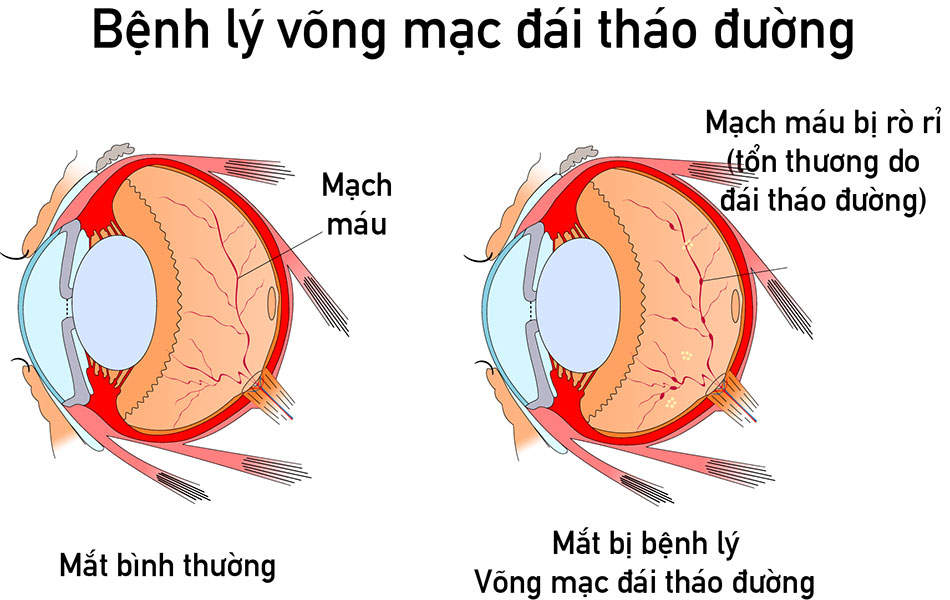 Nam thanh niên nguy cơ mù vĩnh viễn do sai lầm khi điều trị đái tháo đường nhiều người hay mắc phải - Ảnh 1.