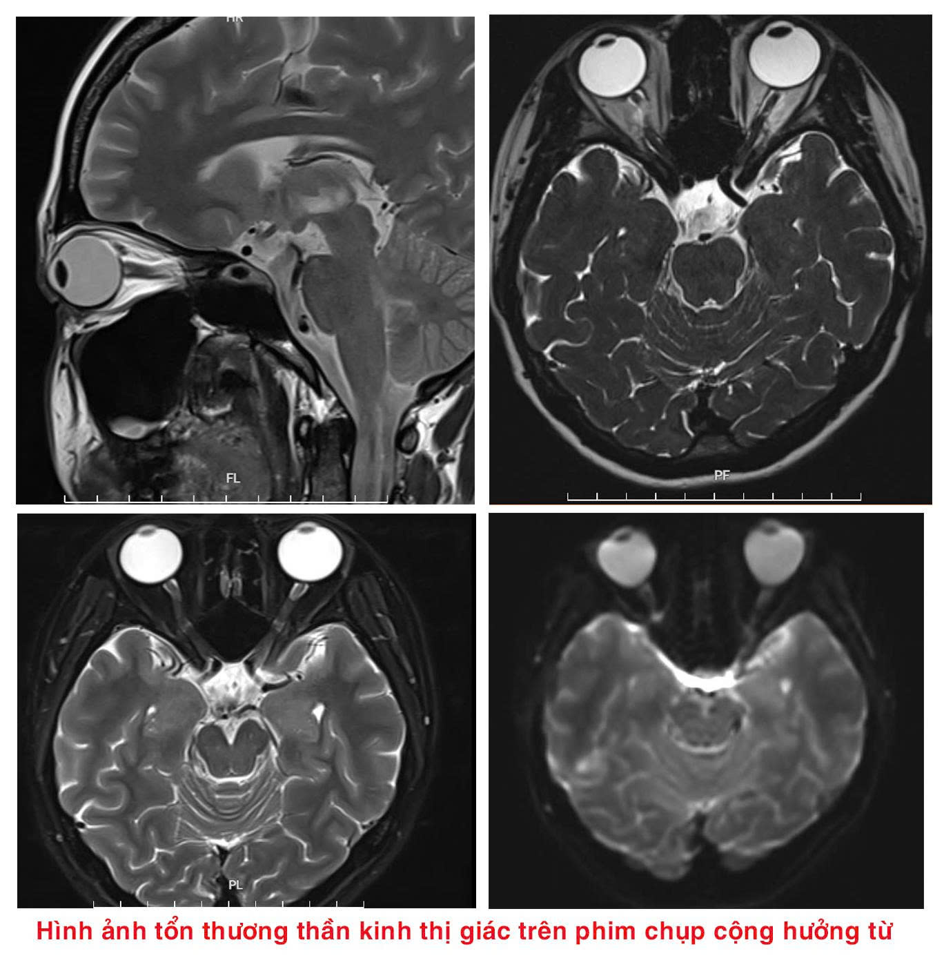 Người phụ nữ 37 tuổi phát hiện viêm tủy hiếm gặp từ dấu hiệu nhiều người Việt mắc phải - Ảnh 1.