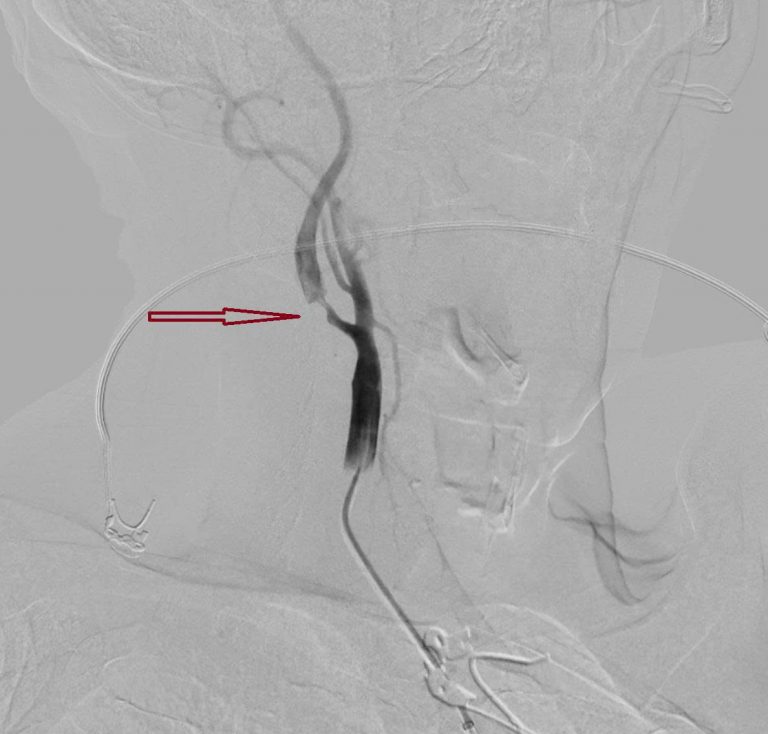 Người đàn ông bất ngờ đột quỵ khi đi du lịch thừa nhận một sai lầm nhiều người Việt mắc phải - Ảnh 1.