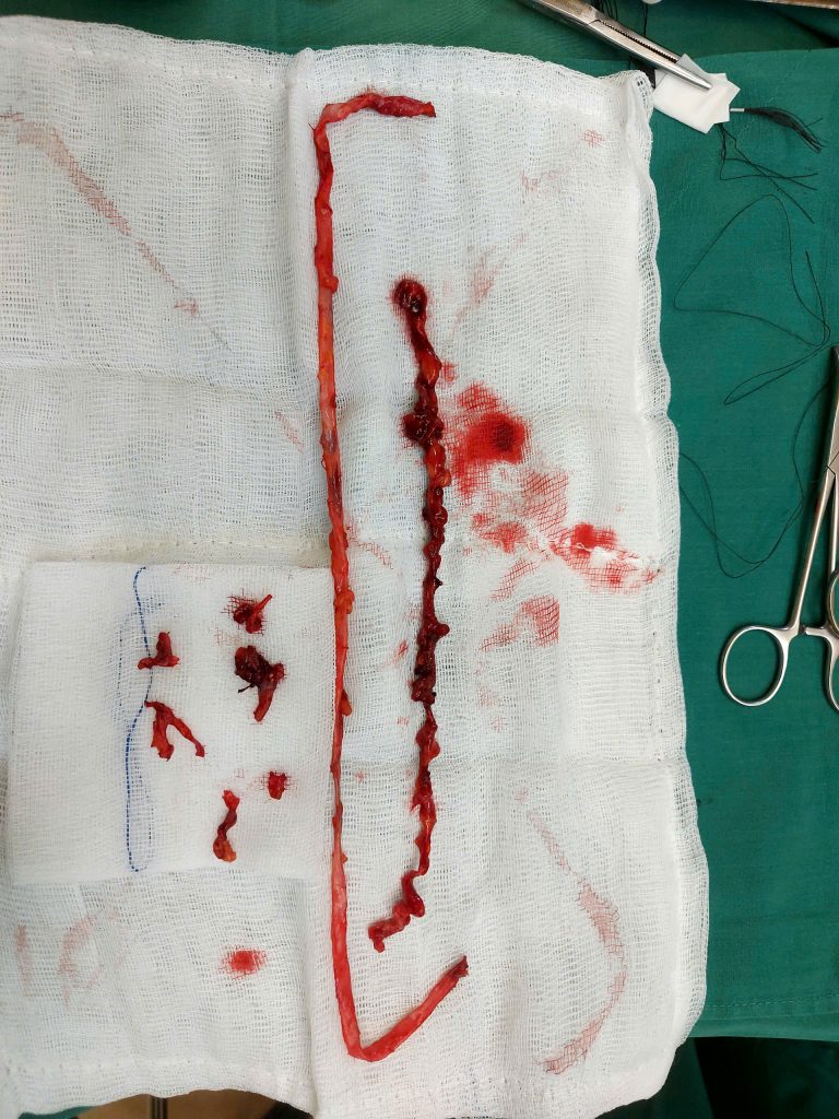 Suy giãn tĩnh mạch: Đừng mắc sai lầm để phải chấp nhận sống chung với bệnh- Ảnh 2.