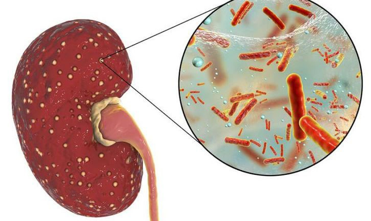 Ai có nguy cơ bị bệnh thận mạn tính và suy thận?- Ảnh 2.