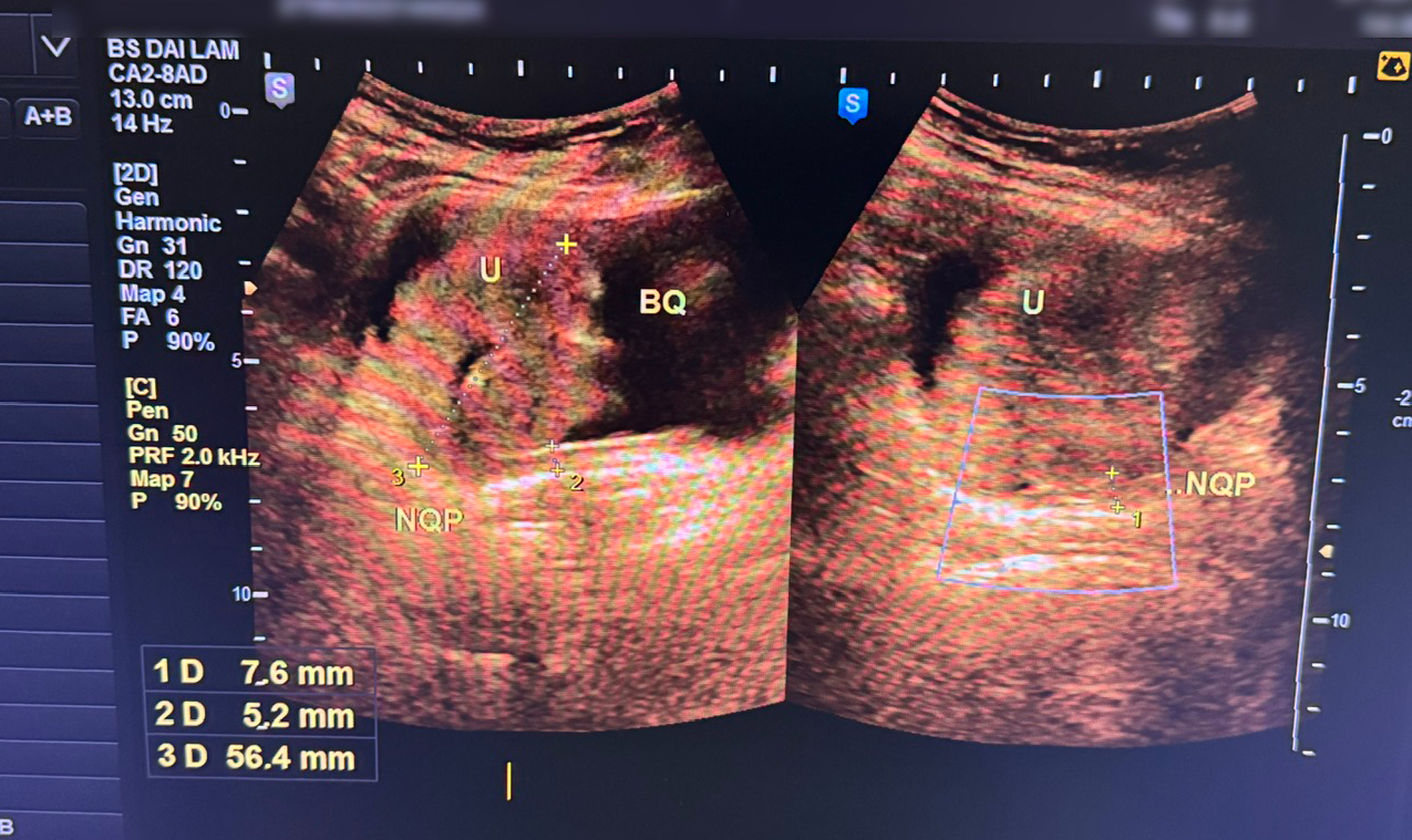 Người phụ nữ 61 tuổi bị u bàng quang từ dấu hiệu nhiều người hay chủ quan - Ảnh 1.