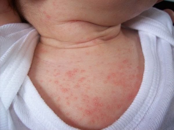 Trẻ bị rôm sảy: Chăm sóc da thế nào? - Ảnh 2.