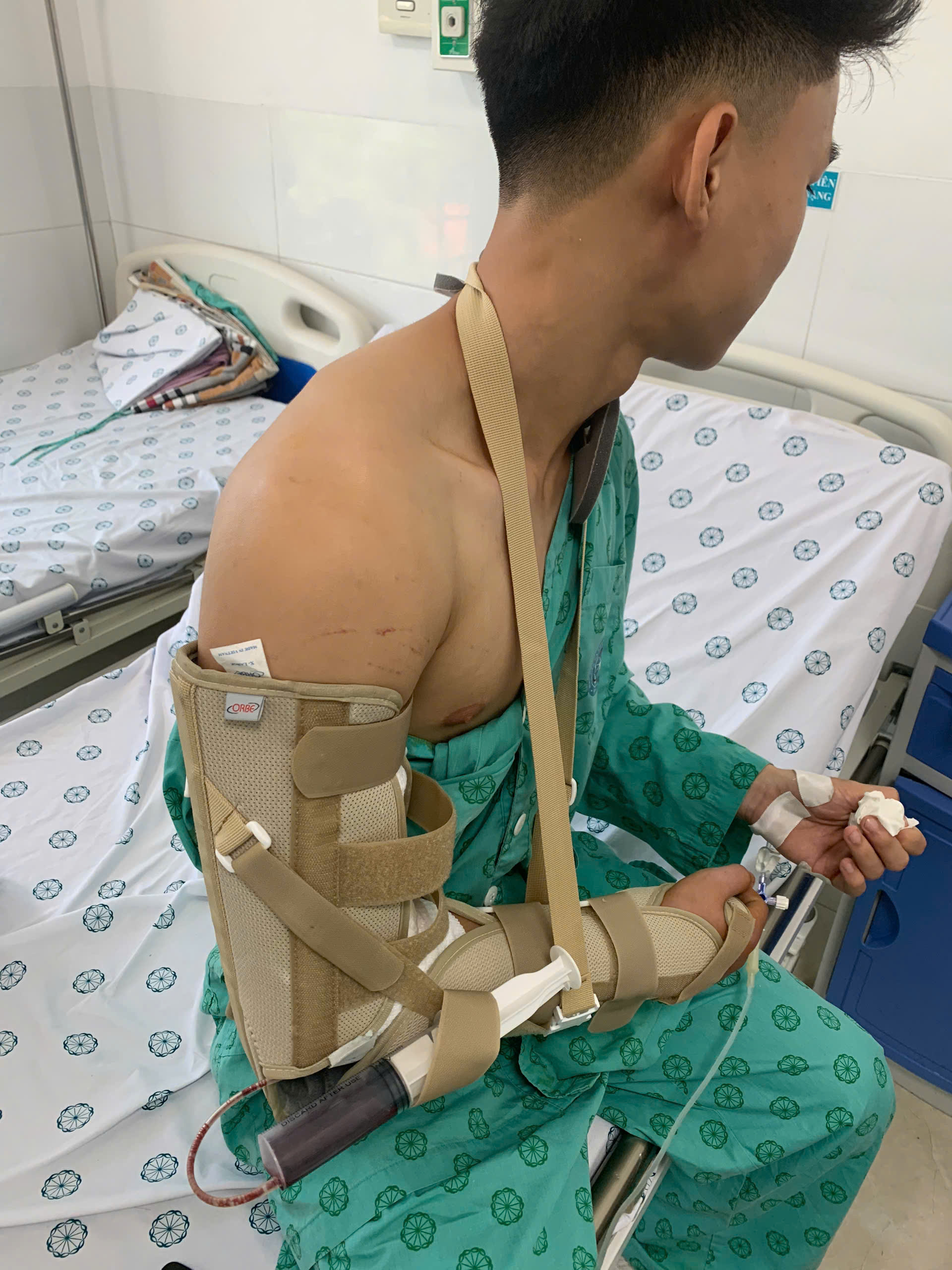 Chơi vật tay với bạn, thanh niên 18 tuổi ở Hà Nội bị gãy xương - Ảnh 1.