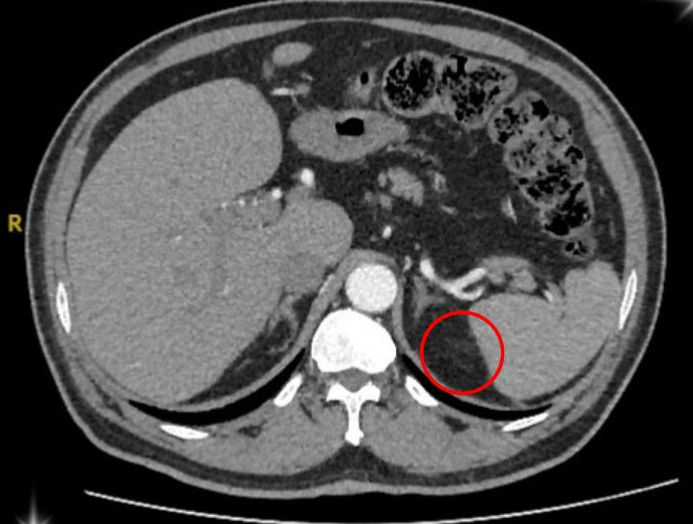 Tăng huyết áp suốt 15 năm chữa mãi không khỏi, người đàn ông 55 tuổi đi khám phát hiện lý do bất ngờ - Ảnh 1.