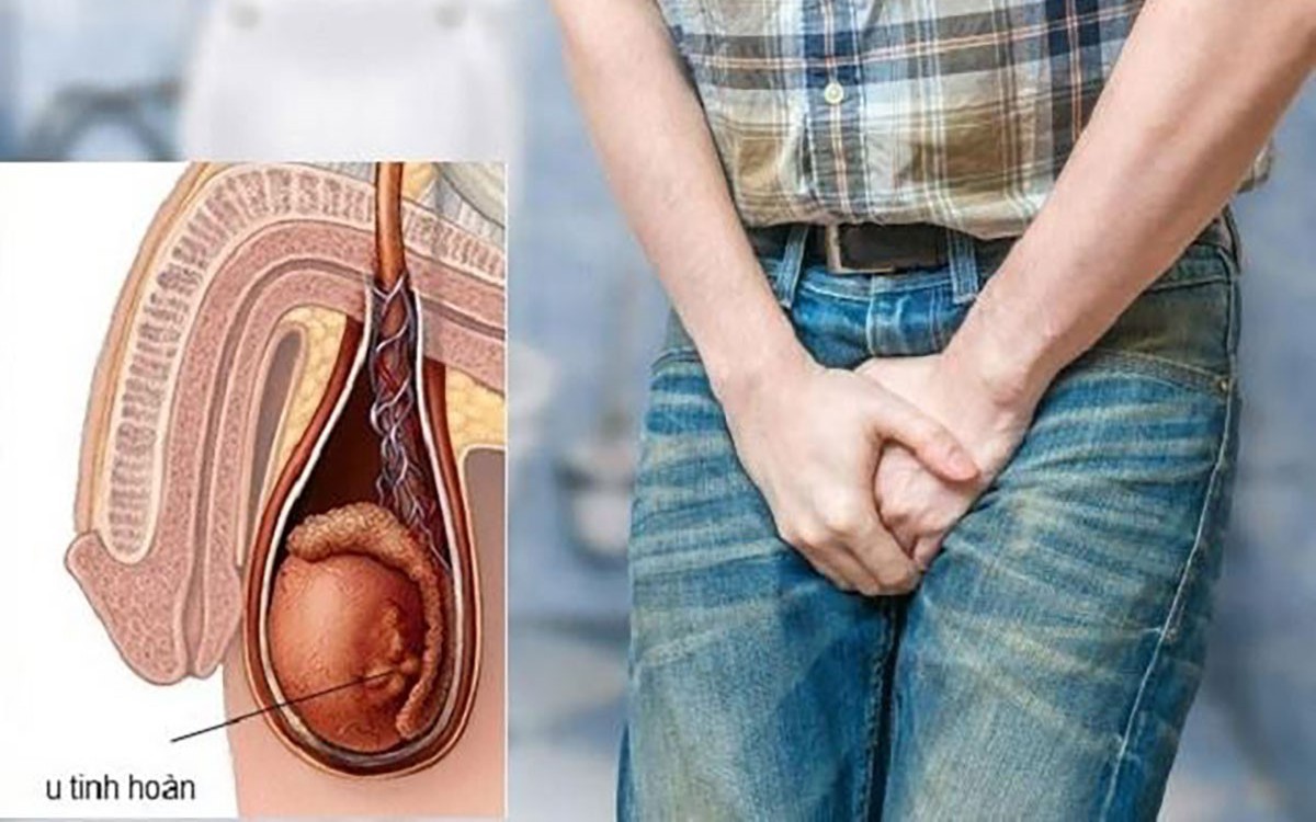 Người đ&agrave;n &ocirc;ng 60 tuổi ph&aacute;t hiện ung thư tinh ho&agrave;n từ dấu hiệu nhiều nam giới Việt bỏ qua