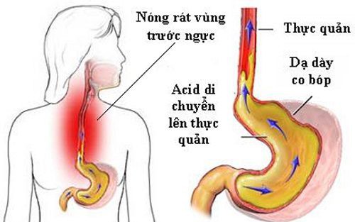 Sau 1 th&aacute;ng nuốt nghẹn, người đ&agrave;n &ocirc;ng 53 tuổi ph&aacute;t hiện ung thư thực quản - Ảnh 2.