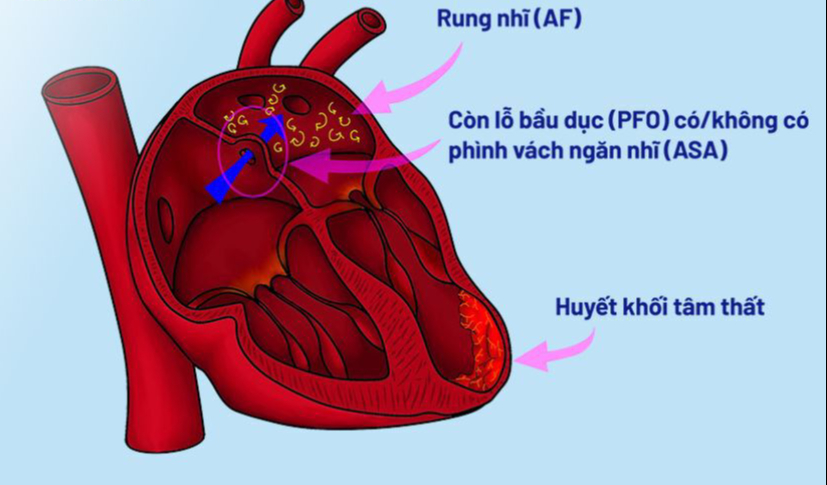 Tìm ra 'thủ phạm' gây đột quỵ: Bác sĩ làm ngay điều này để ngăn ngừa đột quỵ tái phát - Ảnh 2. Tìm ra 'thủ phạm' gây đột quỵ: Bác sĩ làm ngay điều này để ngăn ngừa đột quỵ tái phát - Ảnh 2.