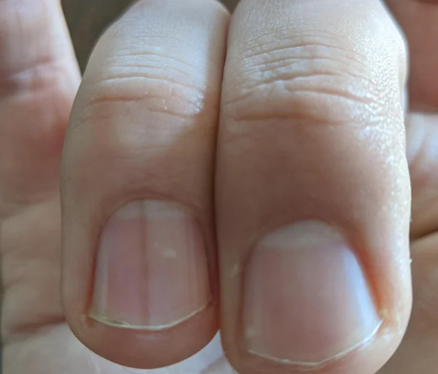 7 bất thường trên móng tay lộ ngay người 'giấu' khối u trong cơ thể, kiểm tra xem bạn có không! - Ảnh 1. 7 bất thường trên móng tay lộ ngay người 'giấu' khối u trong cơ thể, kiểm tra xem bạn có không! - Ảnh 1.