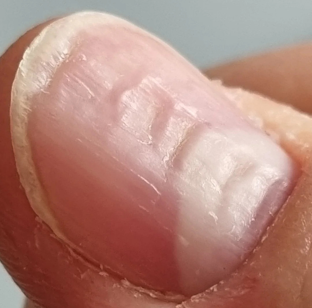 7 bất thường trên móng tay lộ ngay người 'giấu' khối u trong cơ thể, kiểm tra xem bạn có không! - Ảnh 3. 7 bất thường trên móng tay lộ ngay người 'giấu' khối u trong cơ thể, kiểm tra xem bạn có không! - Ảnh 3.