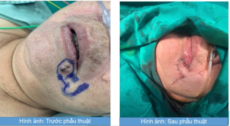 Người phụ nữ bị ung thư da từ dấu hiệu nhiều người Việt mắc phải - Ảnh 1.