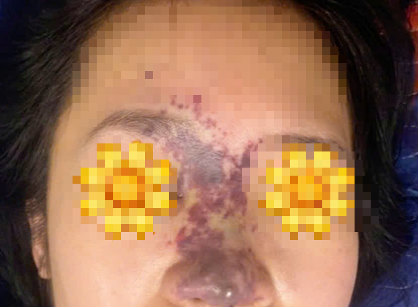 Tiêm filler trôi nổi, có người phải trải qua hơn 60 ca phẫu thuật để xử lý hậu quả - Ảnh 1.