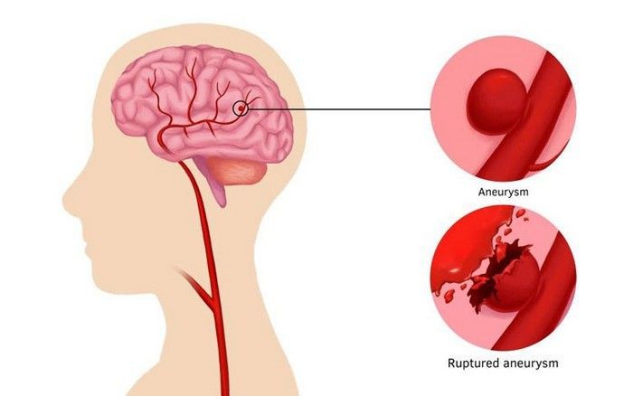 Xuất huyết n&atilde;o: Hiểm họa thầm lặng v&agrave; c&aacute;ch ph&ograve;ng ngừa để bảo vệ n&atilde;o bộ