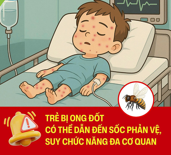 Ba trẻ bị ong đốt: 2 trẻ  tổn thương gan, thận, rối loạn đông máu, tiêu cơ vân và 1 trẻ tử vong  - Ảnh 2.