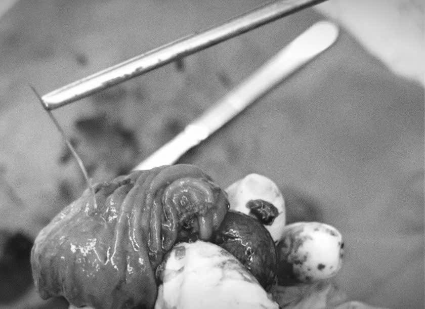 Người đàn ông 33 tuổi nhập viện trong tình trạng đau đớn sau khi ăn bún cá - Ảnh 2.