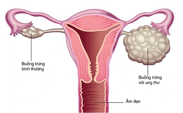 Người phụ nữ 62 tuổi bất ngờ phát hiện ung thư buồng trứng từ dấu hiệu nhiều chị em Việt bỏ qua - Ảnh 2.