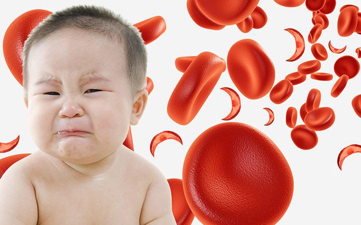 Không chỉ là dáng cao gầy: Hội chứng Marfan tiềm ẩn biến chứng tim mạch gây tử vong - Ảnh 4.