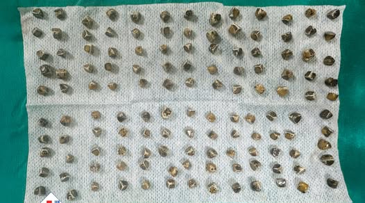 Kết quả bất ngờ: 130 viên sỏi chi chít được lấy ra từ túi mật của nữ bệnh nhân 40 tuổi - Ảnh 1.