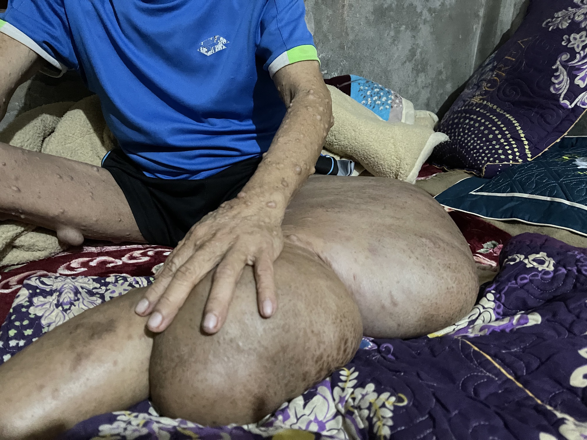 Người đ&agrave;n &ocirc;ng c&oacute; khối u khổng lồ đau x&oacute;t nh&igrave;n vợ con lay lắt v&igrave; bệnh tật - Ảnh 4.