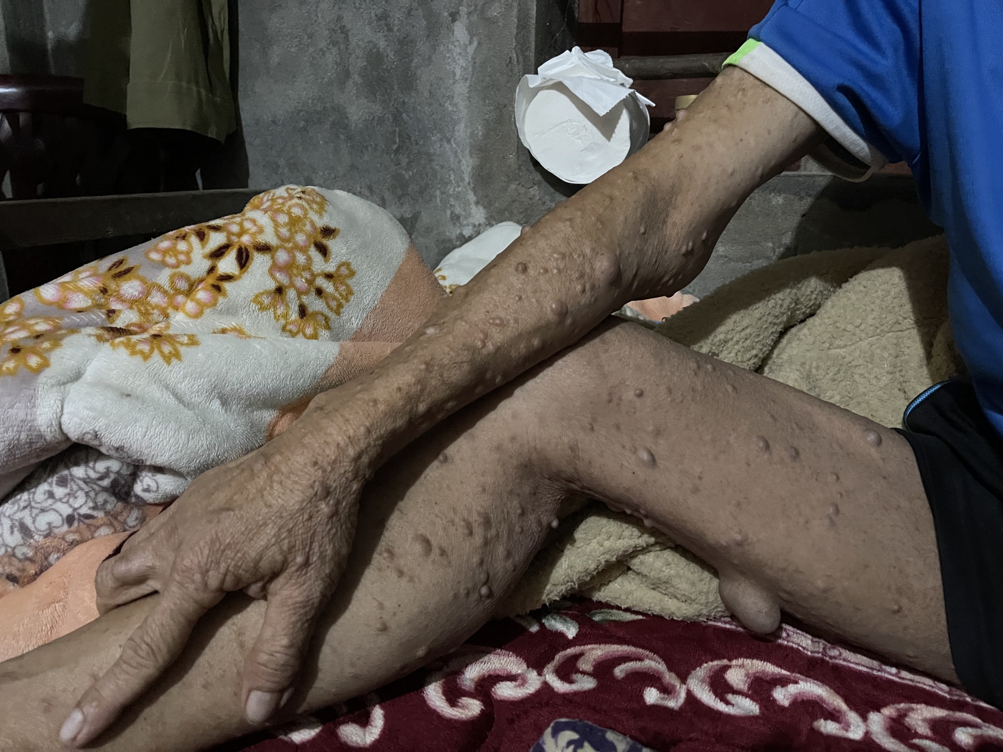 Người đ&agrave;n &ocirc;ng c&oacute; khối u khổng lồ đau x&oacute;t nh&igrave;n vợ con lay lắt v&igrave; bệnh tật - Ảnh 3.