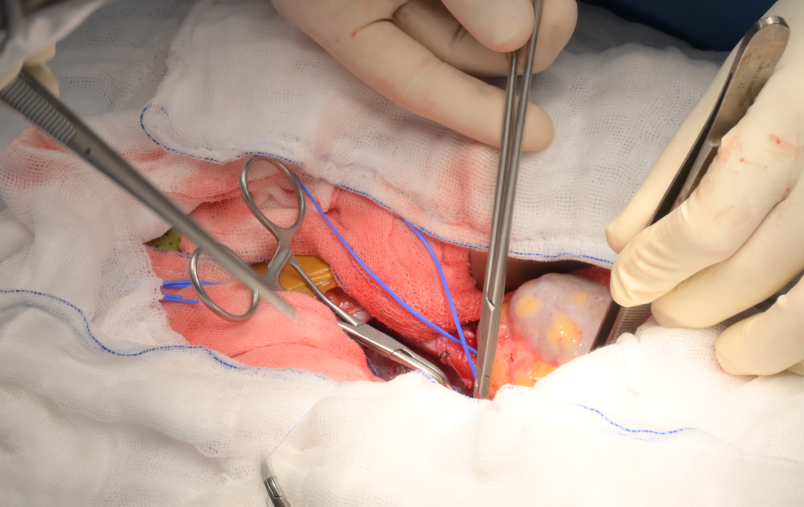 Thanh niên 25 tuổi suy thận giai đoạn cuối, phải ghép thận thừa nhận 1 sai lầm nhiều bạn trẻ Việt mắc phải - Ảnh 1.