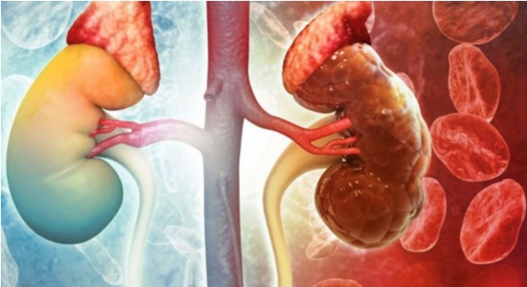 Thanh ni&ecirc;n 25 tuổi suy thận giai đoạn cuối, phải gh&eacute;p thận thừa nhận 1 sai lầm nhiều bạn trẻ Việt mắc phải - Ảnh 2.