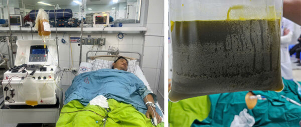 Người đàn ông suy gan cấp, tải lượng virus viêm gan B cao hơn 351 lần từ dấu hiệu nhiều người Việt bỏ qua - Ảnh 1. Người đàn ông suy gan cấp, tải lượng virus viêm gan B cao hơn 351 lần từ dấu hiệu nhiều người Việt bỏ qua - Ảnh 1.