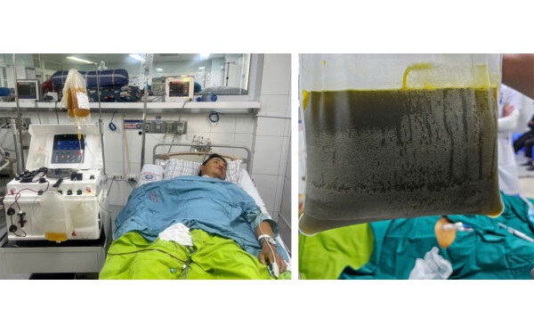 Người đ&agrave;n &ocirc;ng suy gan cấp, tải lượng virus vi&ecirc;m gan B cao hơn 351 lần từ dấu hiệu nhiều người Việt bỏ qua