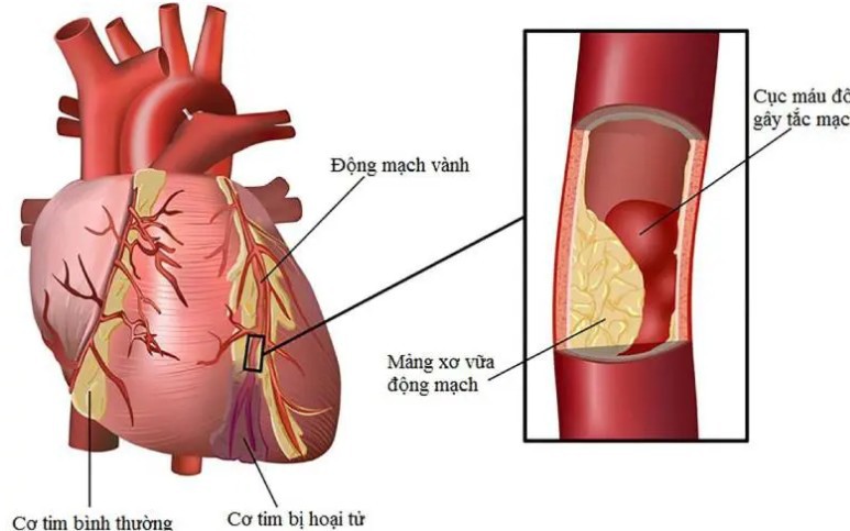 Người đ&agrave;n &ocirc;ng 66 tuổi bị nhồi m&aacute;u cơ tim cấp thừa nhận chủ quan với dấu hiệu cảnh b&aacute;o sớm