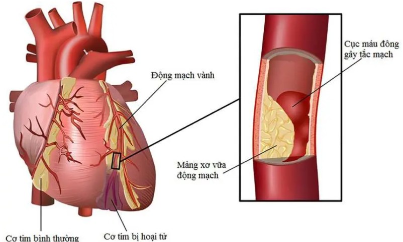 Người đàn ông 66 tuổi bị nhồi máu cơ tim cấp thừa nhận chủ quan với dấu hiệu cảnh báo sớm - Ảnh 1.