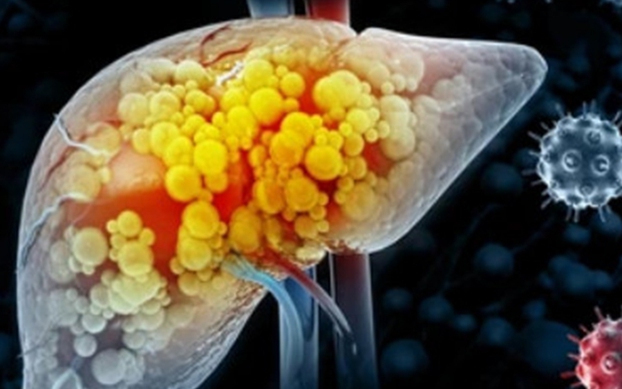 Hai vợ chồng cùng mắc ung thư gan: Cảnh giác 4 loại thực phẩm để lâu trong tủ lạnh - Ảnh 3. Hai vợ chồng cùng mắc ung thư gan: Cảnh giác 4 loại thực phẩm để lâu trong tủ lạnh - Ảnh 3.