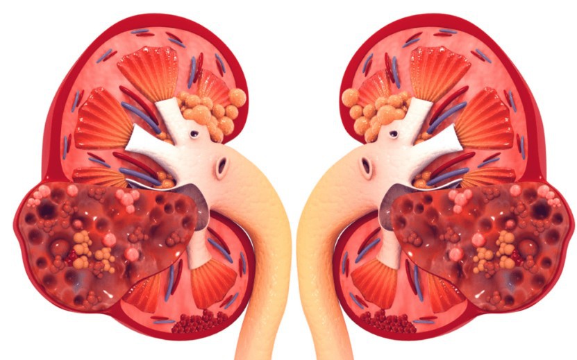 Món ăn rẻ tiền quen thuộc trong bữa cơm Việt, nhưng người bệnh suy thận được khuyến cáo không nên ăn