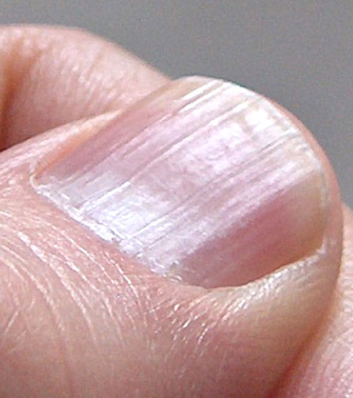 Móng tay nổi sọc dọc báo động nguy hiểm? Đừng chủ quan nếu thấy 4 đặc điểm này - Ảnh 3. Móng tay nổi sọc dọc báo động nguy hiểm? Đừng chủ quan nếu thấy 4 đặc điểm này - Ảnh 3.