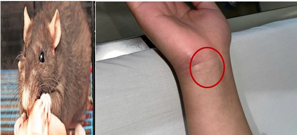 Chủ quan với vết thương do chuột cắn, thanh niên 16 tuổi mắc bệnh nhiễm trùng toàn thân hiếm gặp - Ảnh 2. Chủ quan với vết thương do chuột cắn, thanh niên 16 tuổi mắc bệnh nhiễm trùng toàn thân hiếm gặp - Ảnh 2.