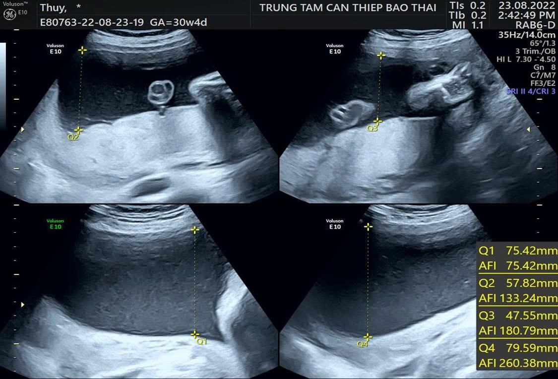 Đa ối ở thai phụ: Nhận diện đ&uacute;ng &ndash; theo d&otilde;i chuẩn &ndash; can thiệp kịp thời để tr&aacute;nh biến chứng - Ảnh 1.