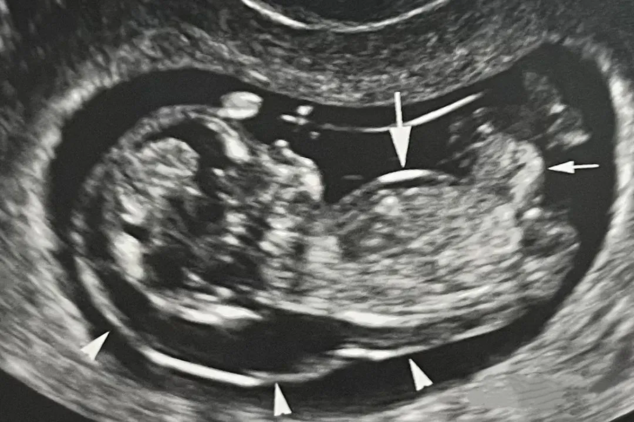 Top 4 dị tật bẩm sinh thường gặp ở trẻ sơ sinh v&agrave; giải ph&aacute;p ph&aacute;t hiện sớm từ trong bụng mẹ - Ảnh 1.