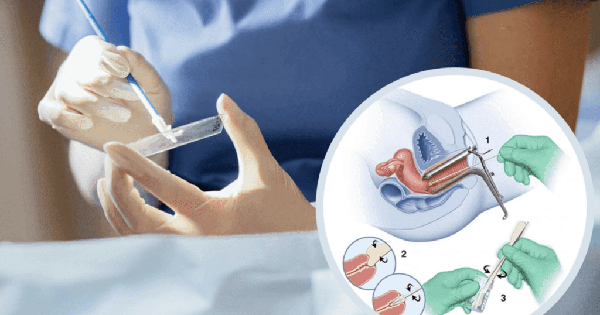 Khi n&agrave;o n&ecirc;n l&agrave;m x&eacute;t nghiệm Pap để s&agrave;ng lọc ung thư cổ tử cung?