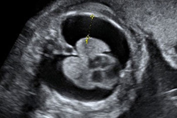 Chọc hút dịch màng phổi thai nhi: Can thiệp đúng cách giúp 'giữ nhịp thở' cho sự sống non nớt - Ảnh 1. Chọc hút dịch màng phổi thai nhi: Can thiệp đúng cách giúp 'giữ nhịp thở' cho sự sống non nớt - Ảnh 1.