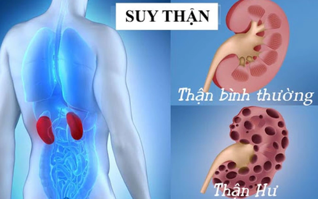 6 nguy&ecirc;n nh&acirc;n &acirc;m thầm g&acirc;y suy thận, ph&aacute; hủy chức năng thận của bạn