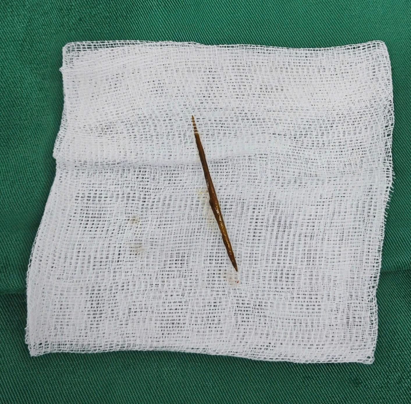 Người đàn ông bị thủng ruột vì một sai lầm nhiều người Việt mắc phải - Ảnh 1.