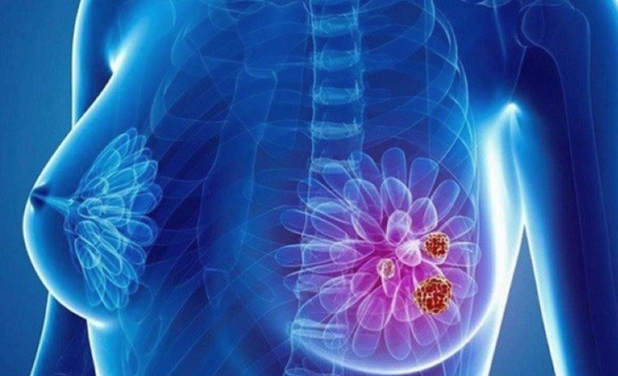 5 vị trí tế bào ung thư dễ 'đột nhập', người Việt nên hiểu đúng để ngừa bệnh từ sớm - Ảnh 3. 5 vị trí tế bào ung thư dễ 'đột nhập', người Việt nên hiểu đúng để ngừa bệnh từ sớm - Ảnh 3.