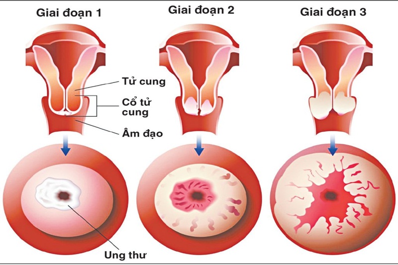 5 vị trí tế bào ung thư dễ 'đột nhập', người Việt nên hiểu đúng để ngừa bệnh từ sớm - Ảnh 6. 5 vị trí tế bào ung thư dễ 'đột nhập', người Việt nên hiểu đúng để ngừa bệnh từ sớm - Ảnh 6.