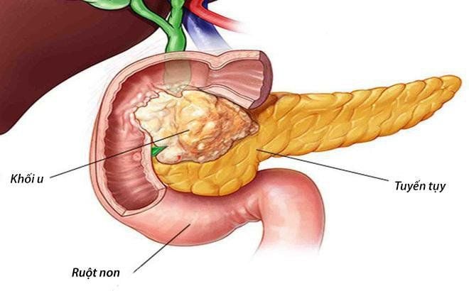 5 vị trí tế bào ung thư dễ 'đột nhập', người Việt nên hiểu đúng để ngừa bệnh từ sớm - Ảnh 4. 5 vị trí tế bào ung thư dễ 'đột nhập', người Việt nên hiểu đúng để ngừa bệnh từ sớm - Ảnh 4.