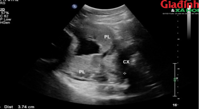 Bé trai 3,7kg chào đời an toàn sau ca mổ cấp cứu 'nghẹt thở' của các bác sĩ Bệnh viện 19-8 - Ảnh 2.