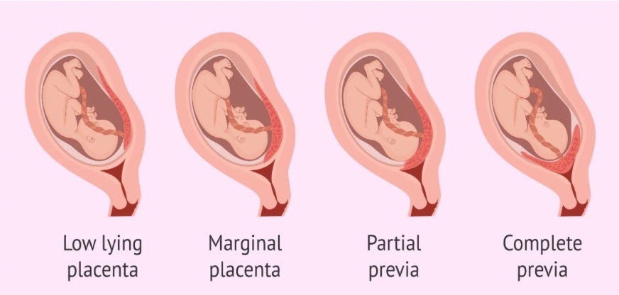Bé trai 3,7kg chào đời an toàn sau ca mổ cấp cứu 'nghẹt thở' của các bác sĩ Bệnh viện 19-8 - Ảnh 1.
