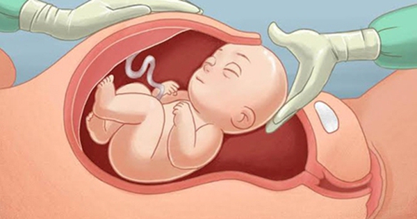 Thai phụ 37 tuổi gặp tai biến nguy hiểm từ vết mổ cũ, b&aacute;c sĩ khuyến c&aacute;o chị em hạn chế l&agrave;m điều n&agrave;y - Ảnh 2.