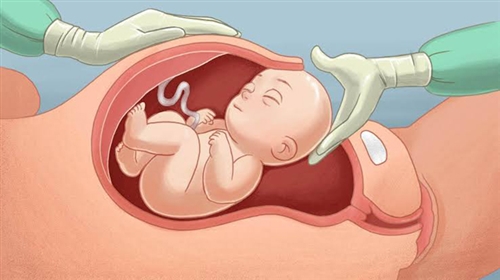 Yếu tố h&igrave;nh th&agrave;nh nhau c&agrave;i răng lược - mối nguy hiểm trong thai kỳ- Ảnh 1.